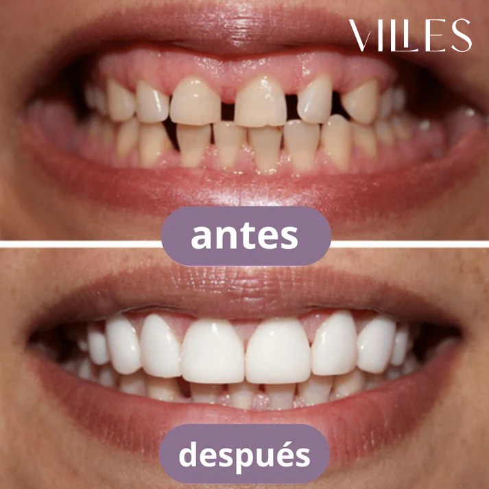 [COMPRÁ 1 Y LLEVÁ 2] Smile Pro® - Carillas Dentales Removibles | Inferior y Superior